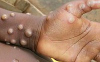 12 quốc gia ghi nhận bệnh đậu mùa khỉ, Việt Nam theo dõi sát sao, giám sát chặt