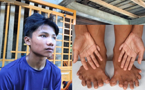 Cậu bé nghèo có 26 ngón chân tay ở Quảng Trị và ước mơ được phẫu thuật