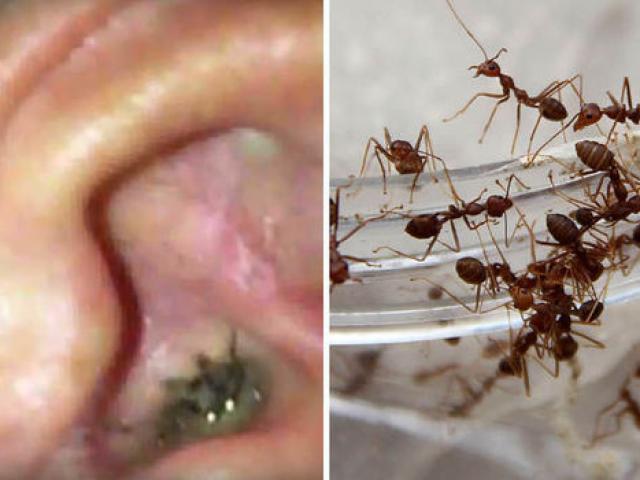 Hoảng sợ với đàn kiến sống thành bầy trong tai bé gái