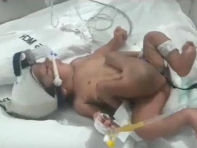 Cậu bé Ấn Độ ra đời với 4 chân, 2 “của quý”