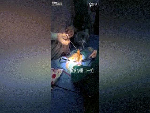 Bác sĩ kéo lươn khổng lồ ra khỏi bụng bệnh nhân