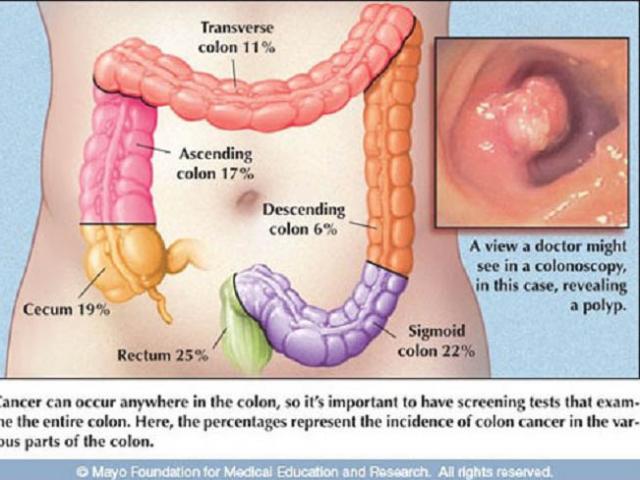 Bác sĩ Bệnh viện K chỉ ra “chìa khóa vàng” để chữa ung thư đại trực tràng