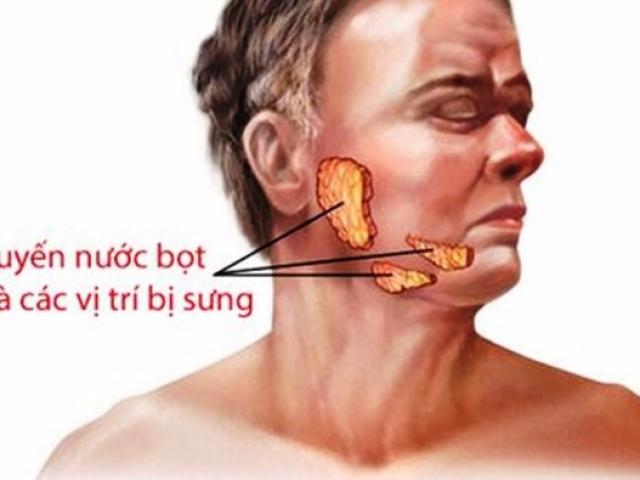 Nhiều người nhầm quai bị với bệnh nguy hiểm