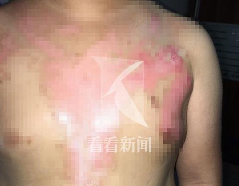  Cậu bé với vết bỏng cấp độ 3 trên ngực sau khi gặp tai nạn trong nhà hàng