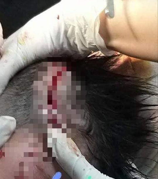 Vết thương trên đầu bé trai 4 tuổi do bị con chó becgie cắn - Ảnh: Bệnh viện Hà Tĩnh