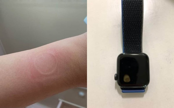 Apple Watch quá nhiệt gây bỏng tay người dùng - Ảnh 1.