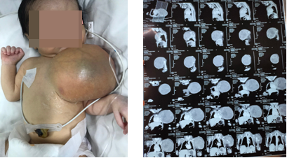 Bé sơ sinh 3 ngày tuổi mang khối u to bằng nửa thân người - Ảnh 1.