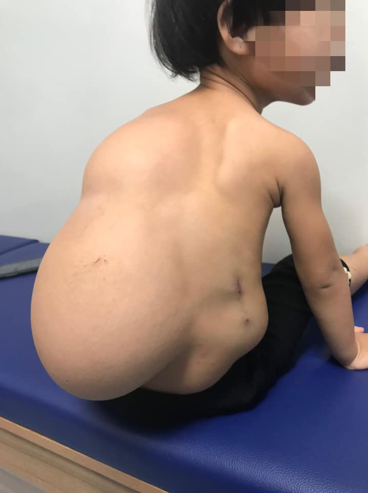 Bé gái 2 tuổi biến dạng cột sống vì khối u quái 4kg - Ảnh 1.