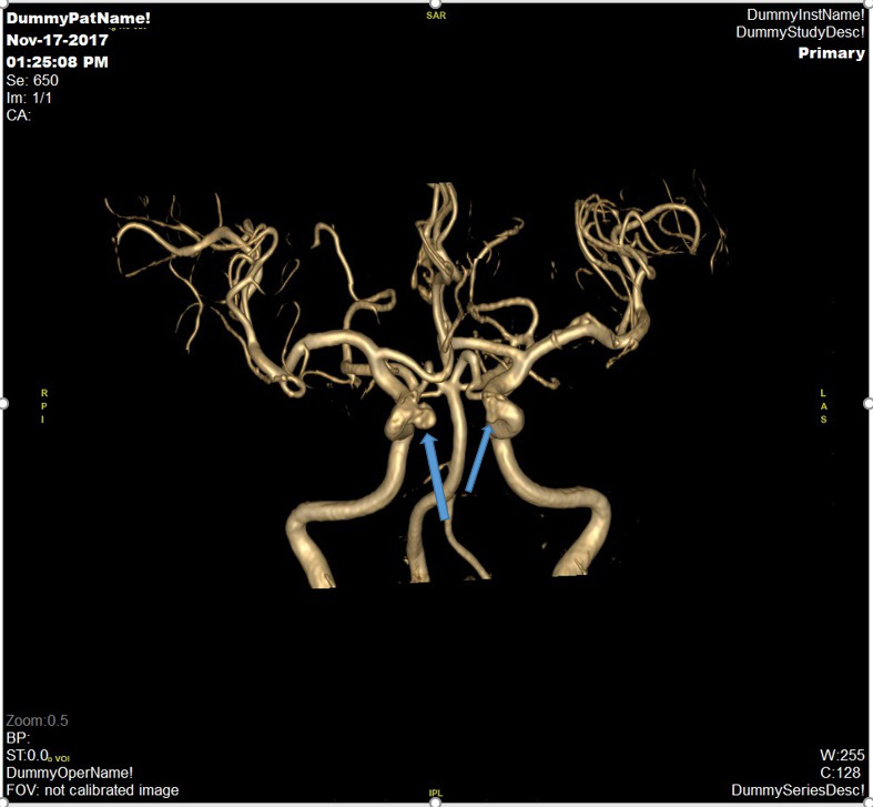 Đột quỵ não và vai trò của chụp cộng hưởng từ (MRI) trong tầm soát đột quỵ - Ảnh 2.