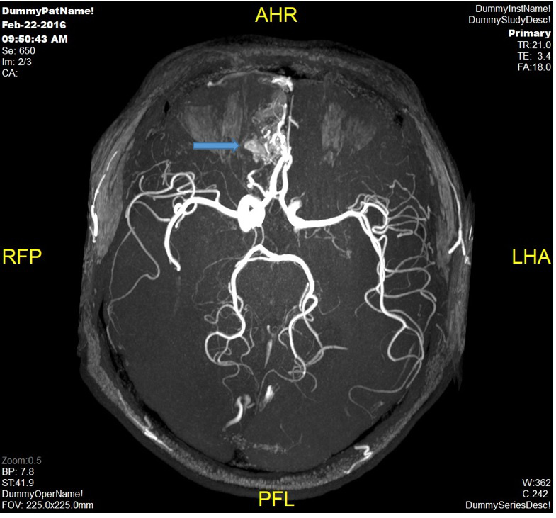 Đột quỵ não và vai trò của chụp cộng hưởng từ (MRI) trong tầm soát đột quỵ - Ảnh 4.