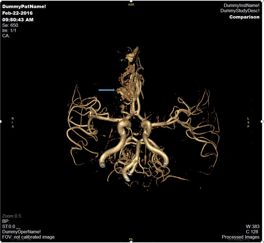 Đột quỵ não và vai trò của chụp cộng hưởng từ (MRI) trong tầm soát đột quỵ - Ảnh 3.