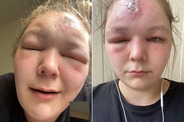 Phơi nắng suốt 2 tiếng, cô gái trẻ bị mù tạm thời vì ngộ độc ánh nắng mặt trời - Ảnh 1.