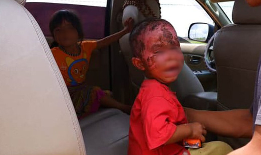 Cháu bé 3 tuổi bị bỏng vùng mặt, gia đình để cho vết thương...tự lành - Ảnh 2.