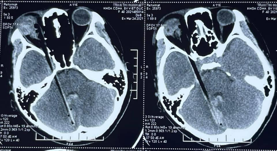 Bị cành cây đâm xuyên qua hốc mắt vào sọ não vẫn sống sót - Ảnh 1.