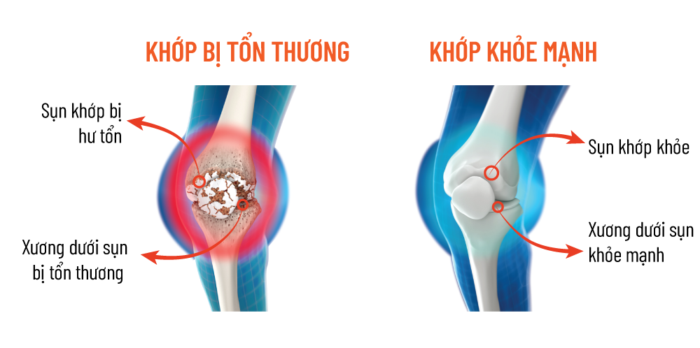 30% người trẻ Việt bị đau xương khớp - Ảnh 2.