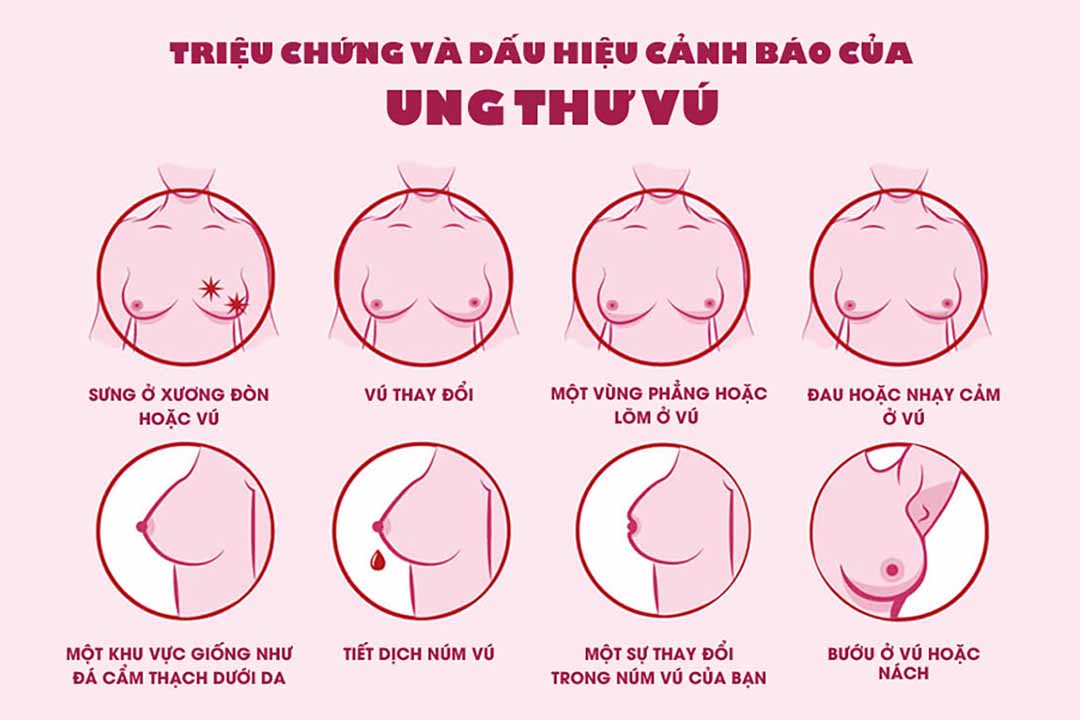 Thứ trưởng Bộ Y tế kêu gọi chị em khám sàng lọc bệnh ung thư vú - Ảnh 2.