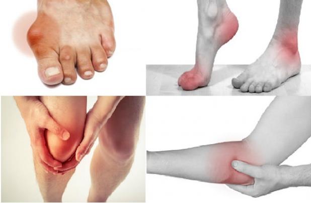 Biến chứng của bệnh gout và cách cải thiện từ Hoàng Thống Phong - Ảnh 1.