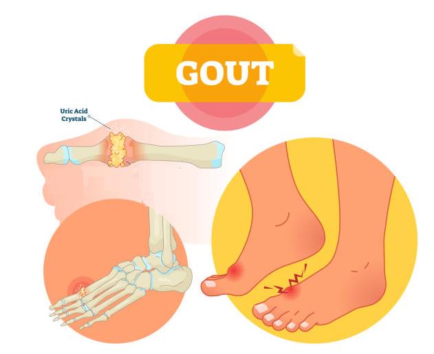 Biến chứng của bệnh gout và cách cải thiện từ Hoàng Thống Phong - Ảnh 2.