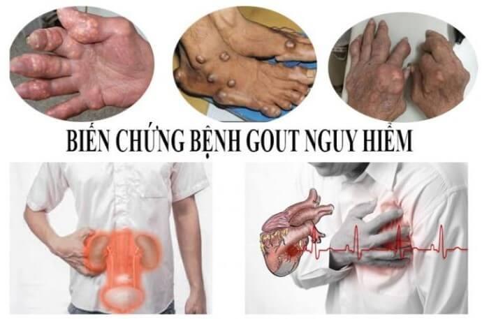 Biến chứng của bệnh gout và cách cải thiện từ Hoàng Thống Phong - Ảnh 3.