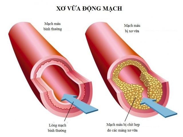 Sức khỏe quý ông: Đừng cam chịu vì nghĩ RLCD không chữa khỏi - Ảnh 3.