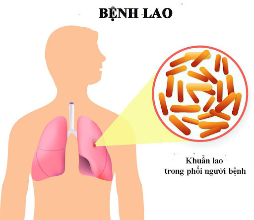 Đừng chần chừ đi khám khi ho, sốt, sút cân, coi chừng bị mắc bệnh lao - Ảnh 1.