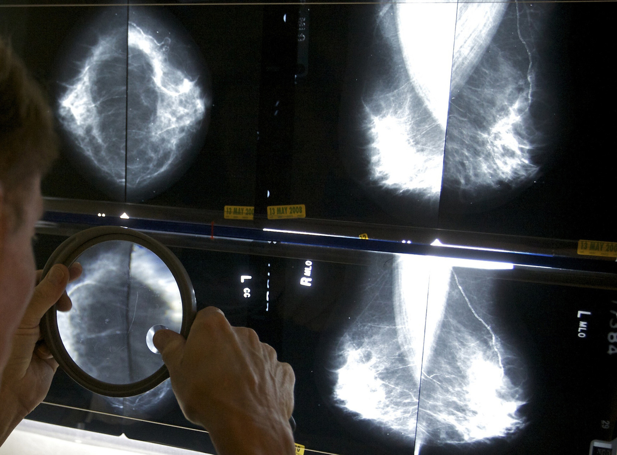 AstraZeneca công bố kết quả 'đột phá' trong thử nghiệm thuốc điều trị ung thư vú mới. Ảnh: @AFP.