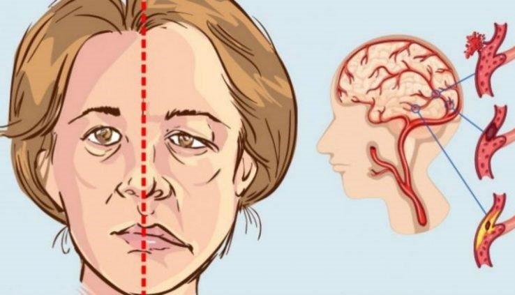 Vì sao bị thiểu năng tuần hoàn não nên dùng Kinh Vương Não Bộ? - Ảnh 2.