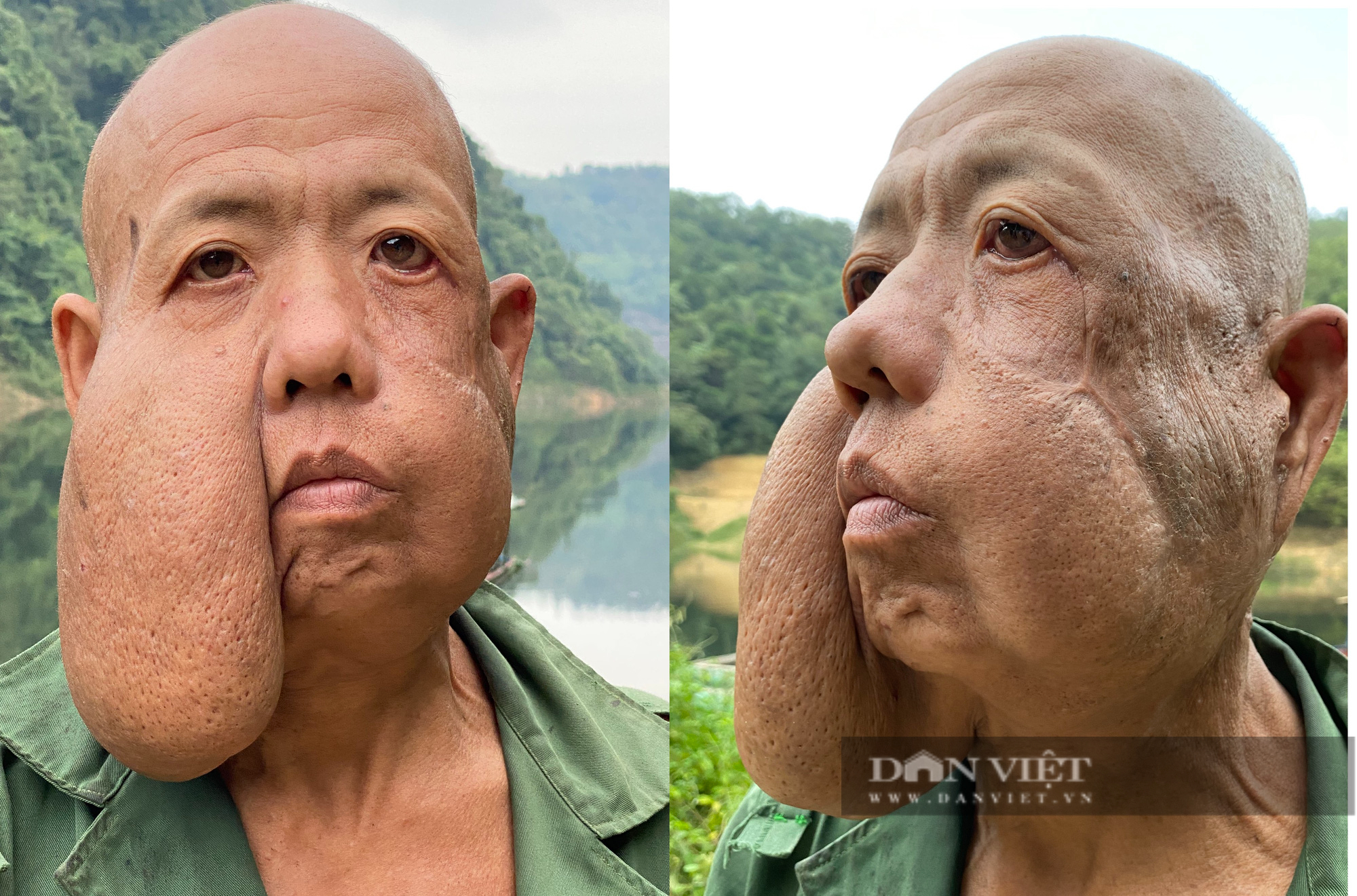 Lai Châu: Người đàn ông có khối u kỳ dị đã có khuôn mặt mới - Ảnh 2.