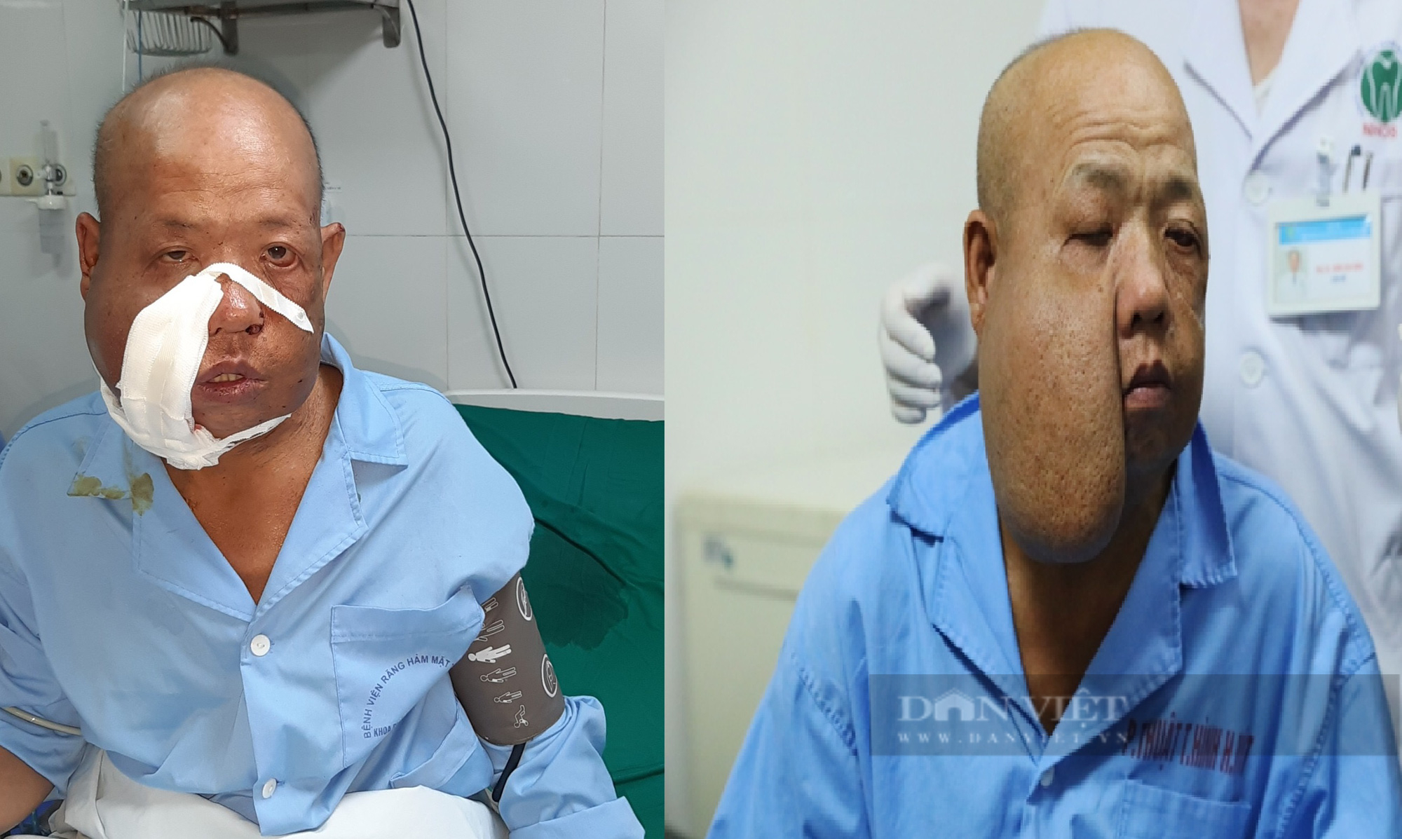 Lai Châu: Người đàn ông có khối u kỳ dị đã có khuôn mặt mới - Ảnh 3.