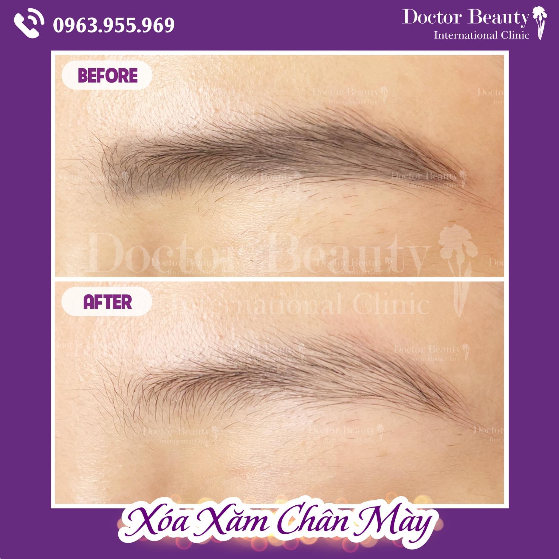 Doctor beauty international Clinic miễn phí xóa xăm chân mày - Ảnh 2.