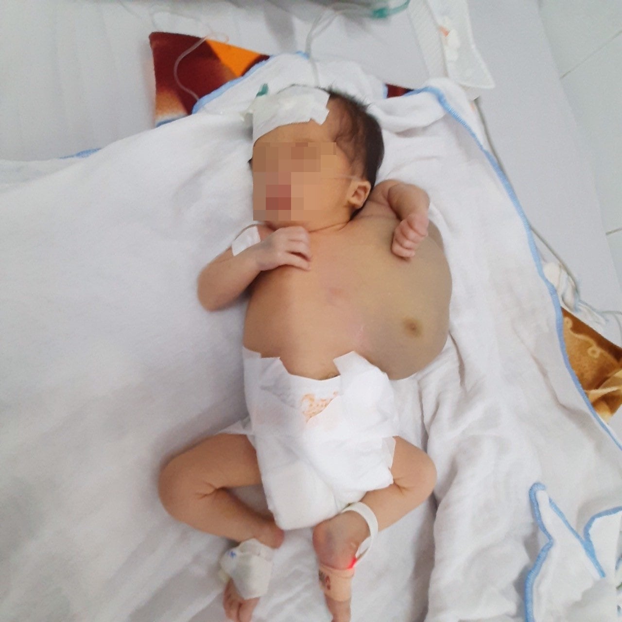 Phẫu thuật u bạch huyết khổng lồ cho trẻ sơ sinh 10 ngày tuổi - Ảnh 1.