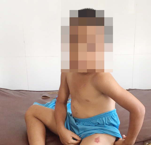 Bé trai 6 tuổi bị cha dượng bạo hành, châm thuốc lá đang cháy vào cơ thể - Ảnh 1.