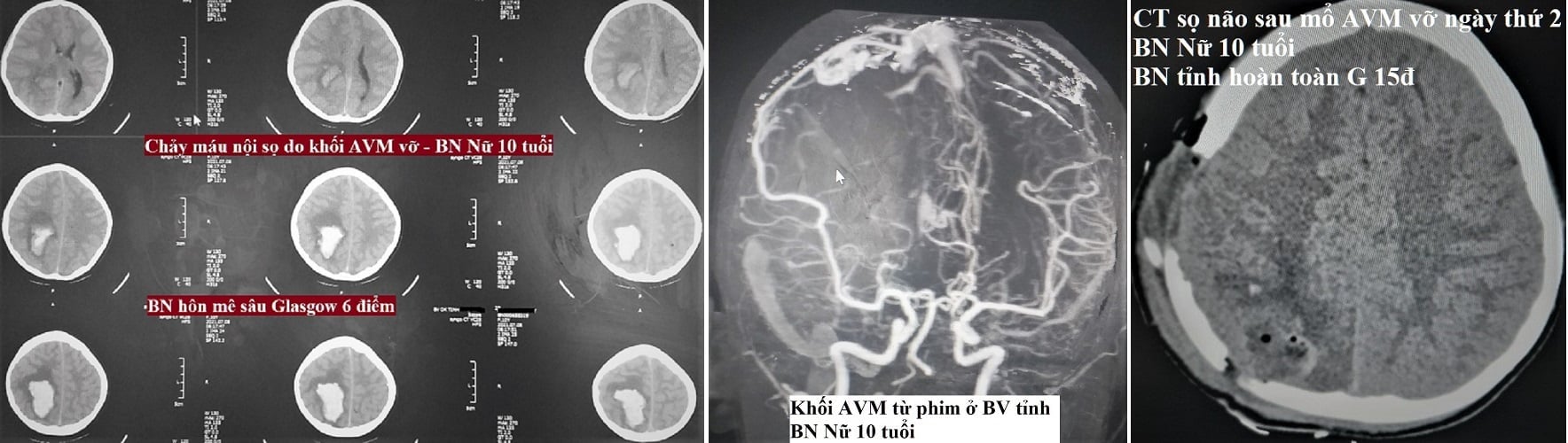 10 tuổi đã đột quỵ do dị dạng mạch máu não - Ảnh 1.