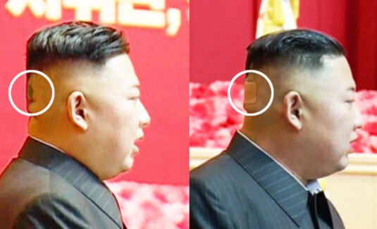 Kim Jong-un xuất hiện với vết bầm lớn sau đầu, khiến giới tình báo bối rối - Ảnh 1.