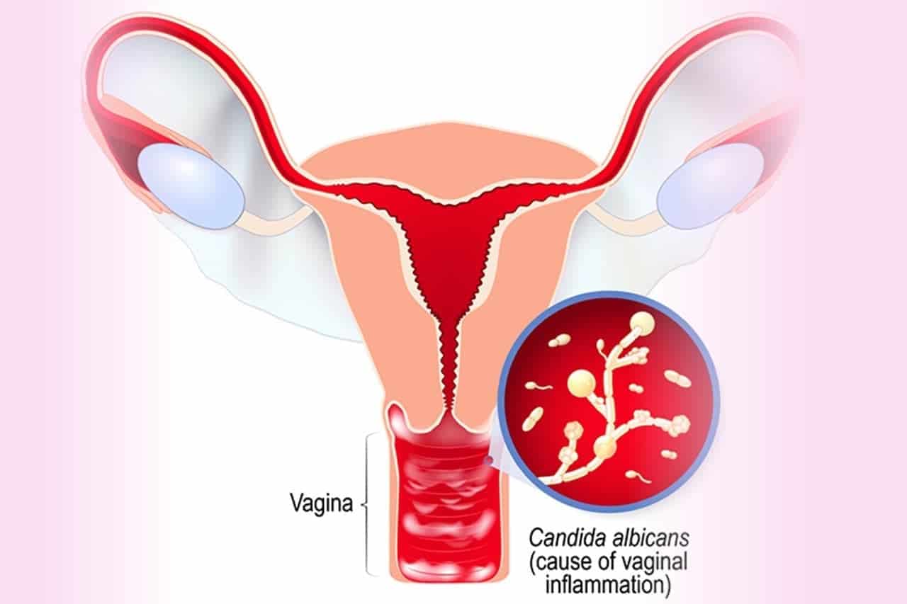 Nguy cơ viêm nhiễm âm đạo do thiếu “vi khuẩn” - Ảnh 1.