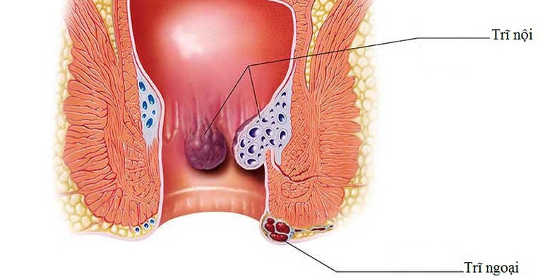 Chữa bệnh trĩ tận gốc mà không cần phẫu thuật - Ảnh 1.