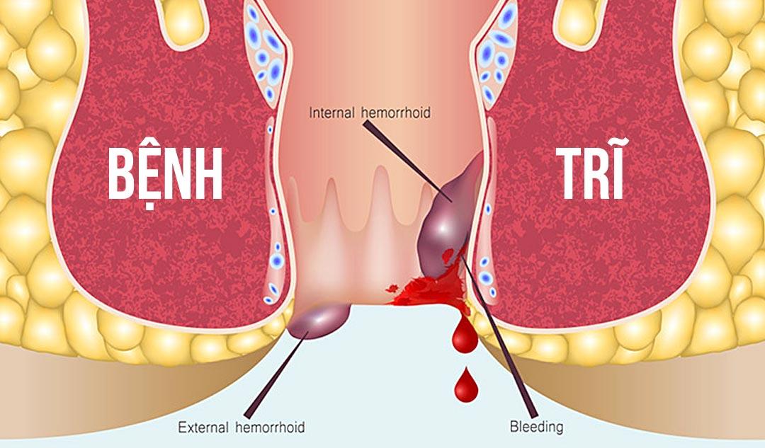 Bệnh trĩ được phân loại, sẽ giúp điều trị hiệu quả - Ảnh 1.