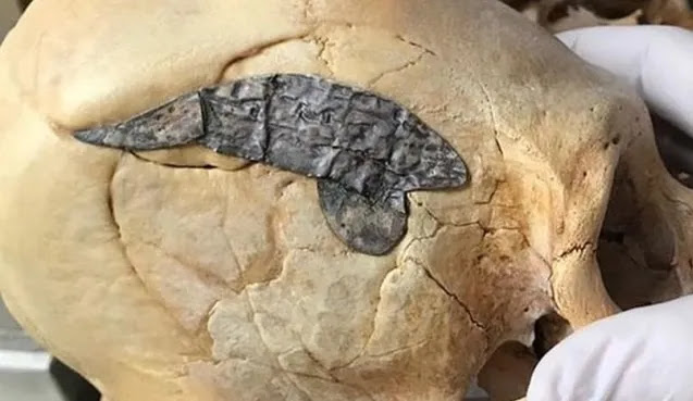 Các nhà khoa học choáng váng khi tìm thấy hộp sọ 2.000 năm tuổi được gắn kim loại - Ảnh 1.