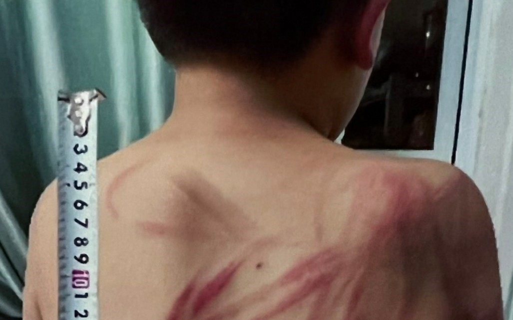 Vụ bố bạo hành con đẻ ở Đà Lạt: Lãnh đạo thành phố thăm hỏi cháu bé