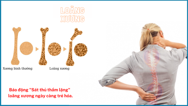 Chăm Sóc Sức Khỏe Việt: Báo động Loãng xương ngày càng trẻ hóa và cách phòng ngừa, xử trí! - Ảnh 3.