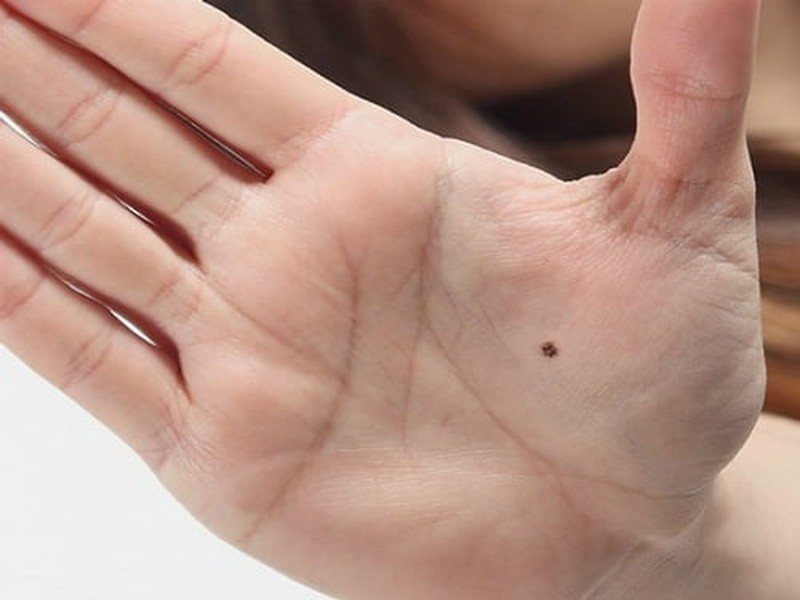 4 nốt ruồi giàu sang trên cơ thể: Có 1/4 cũng sung túc cả đời - Ảnh 1.