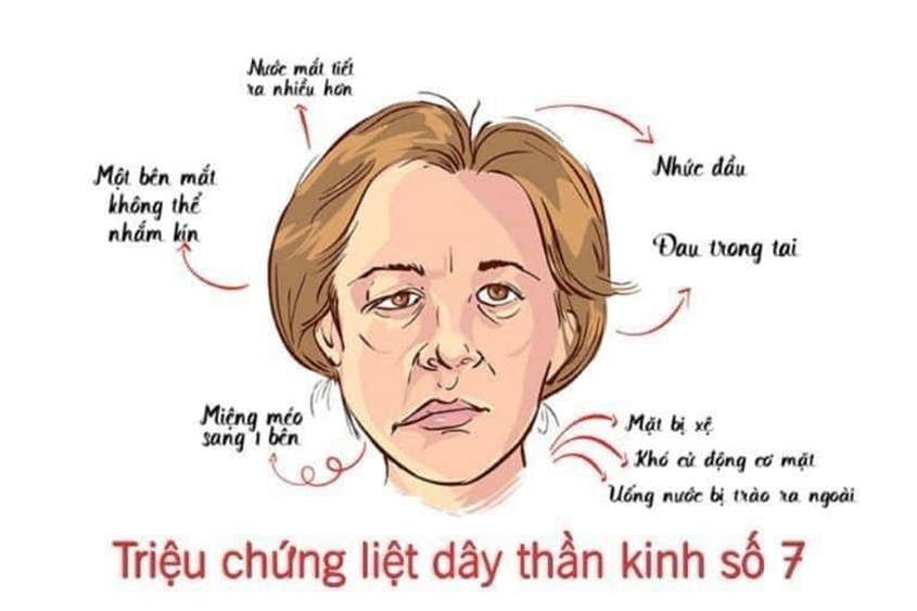 Trời trở lạnh, cảnh giác với bệnh &quot;bỗng dưng liệt mặt&quot;  - Ảnh 2.