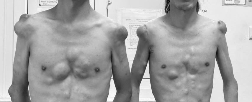 Bệnh quái khiến hàng trăm khối u mọc chi chít trên thân thể của 2 anh em sinh đôi  - Ảnh 1.