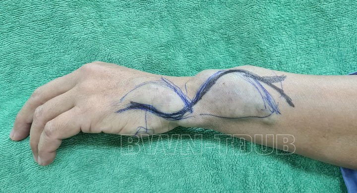 Phẫu thuật khối dị dạng mạch máu lớn gây biến dạng cổ tay - Ảnh 1.