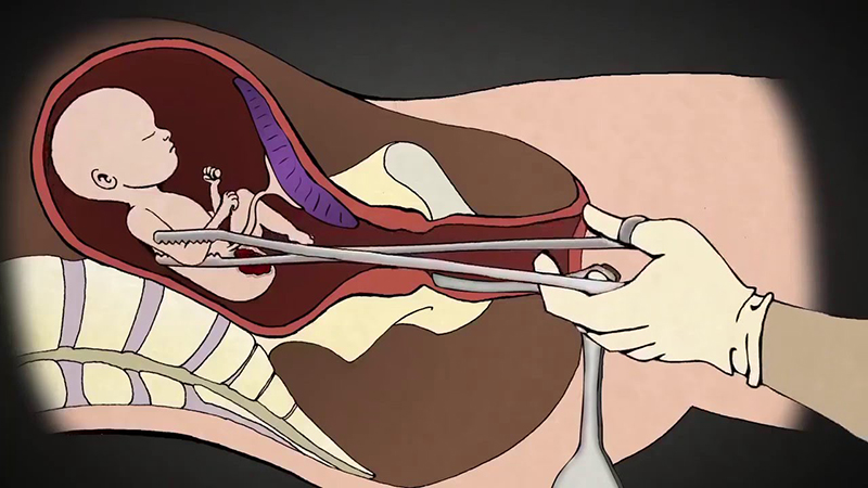 Chuyện trong phòng khám sản: Bác sĩ giật mình khi người phụ nữ tiết lộ số lần nạo phá thai gây sốc  - Ảnh 3.