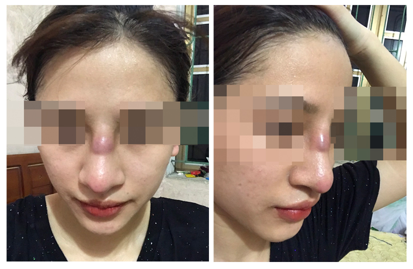Vụ cô gái 22 tuổi tử vong vì nâng mũi: Những biến chứng nguy hiểm khi phẫu thuật nâng mũi - Ảnh 2.