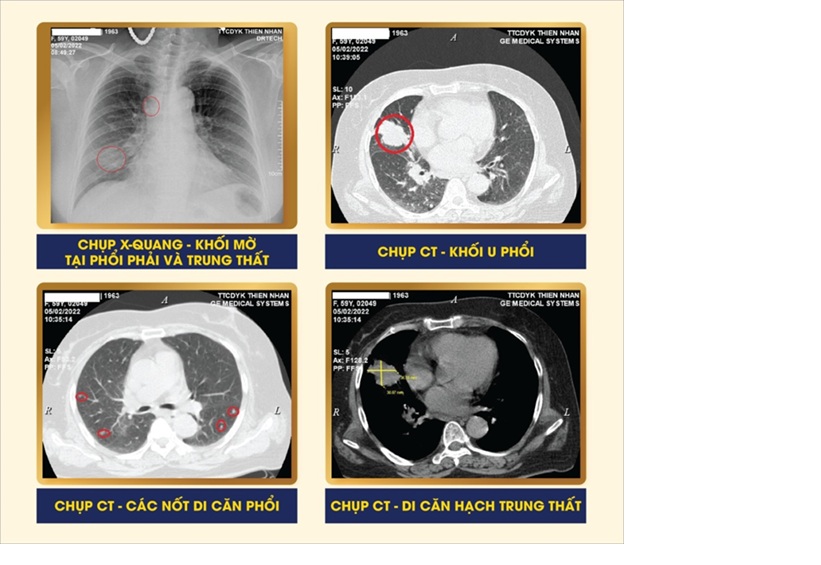 Tá hỏa phát hiện ung thư phổi khi đi khám dạ dày - Ảnh 1.