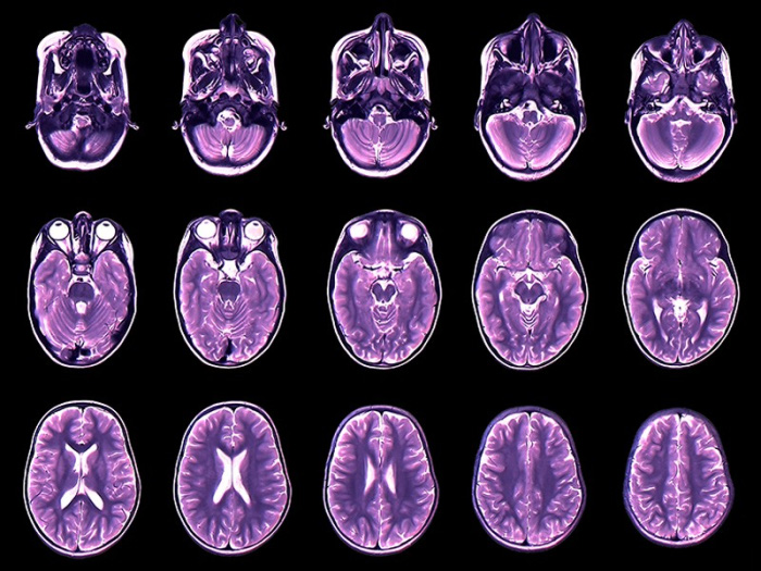 Does the human brain change size with age?  - Photo 1.