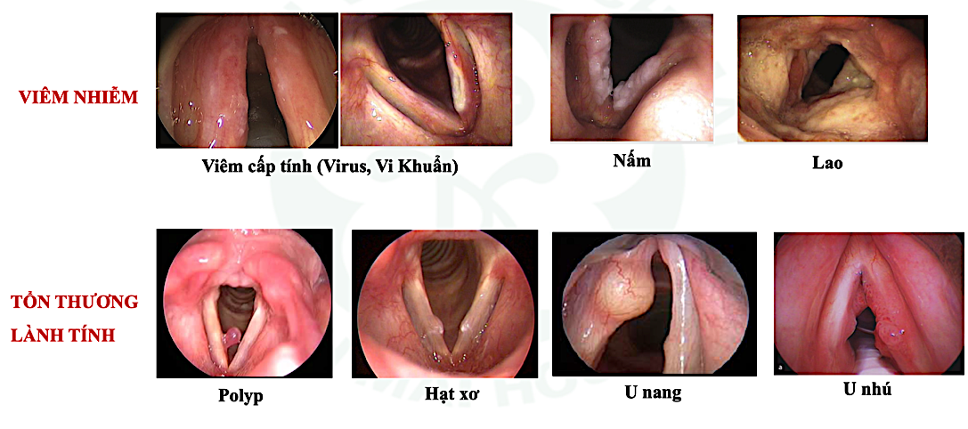 Rối loạn giọng nói coi chừng ung thư thanh quản, u não - Ảnh 3.