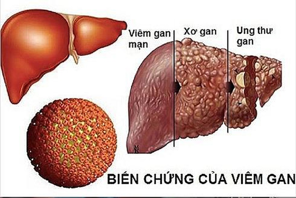 Rối loạn tiêu hóa, bụng chướng, sụt cân, coi chừng ung thư gan  - Ảnh 2.